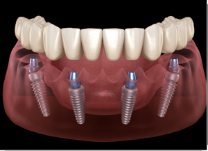 Zubni implantati Crna Gora (all on 4)