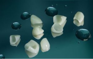 Keramičke fasete (viniri) Podgorica