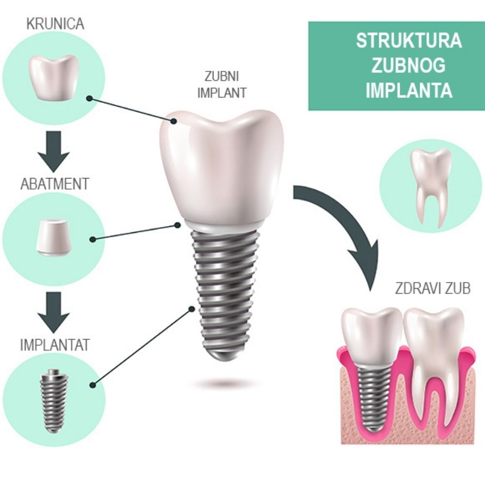 Zubni implanti - Struktura