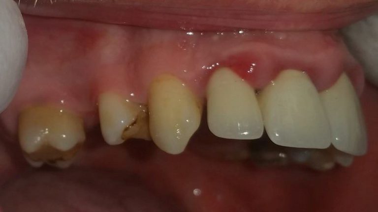 Zubi u lošem stanju