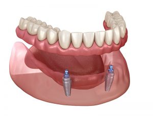 Zubni implantati Crna Gora (totalna proteza na 2 mini implanta)