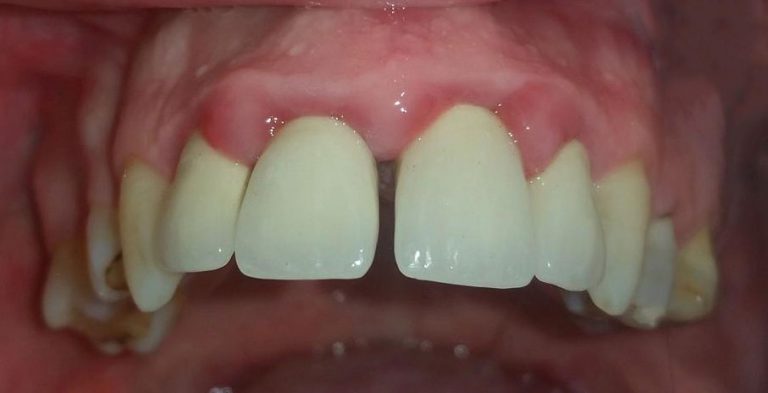 Zubi u lošem stanju, prije postvaljanja novog cirkonijum mosta