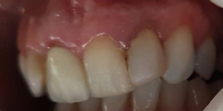 Stanje zuba prije postavke bezmetalnih krunica