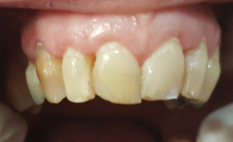 Stanje istrosenih, liječenih zuba više puta