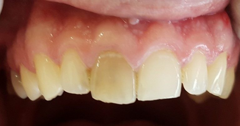 Stanje prije izbjeljivanja zuba i postavljanja bezmetalne krunice