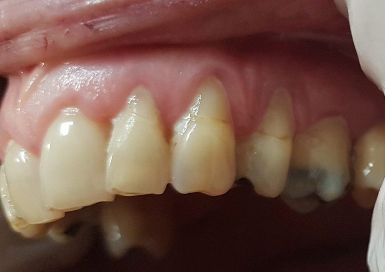Stanje istrosenih, liječenih zuba više puta