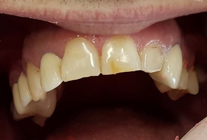 Stanje zuba prije ugradnje cirkonijum krunica