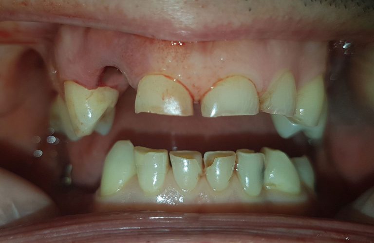 Stanje zuba prije postavljanja metalokeramickih mostova