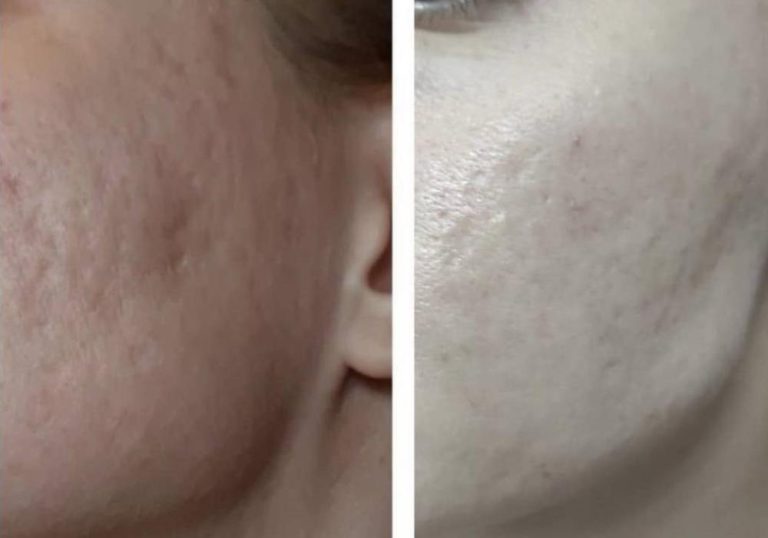 kolagen tretman za lice prije i posle