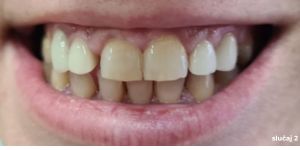 Zubi prije intervencije, potrebno je poromijeniti i oblik i boju krunicama