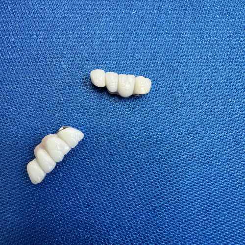 Zubni mostovi fiksne nadoknade