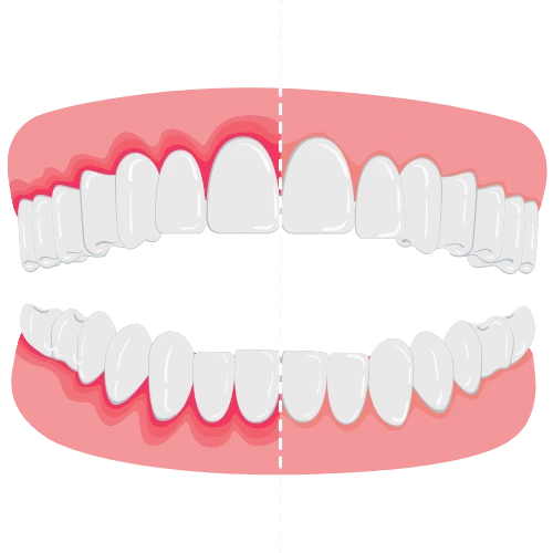 Ilustracija zuba i desni, na jednoj strani su prikazane zdrave desni a na drugoj upaljenje desni.