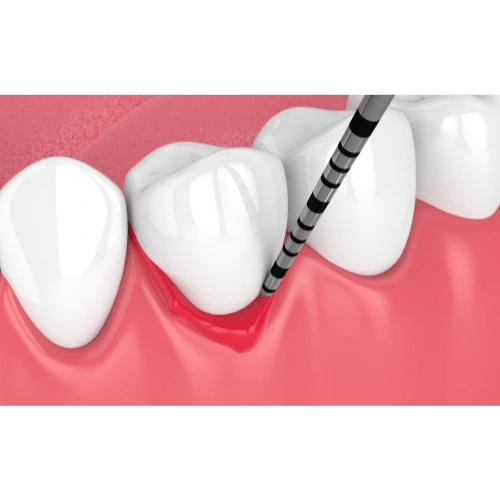 ilustracija za čišćenje parodontalnih džepova