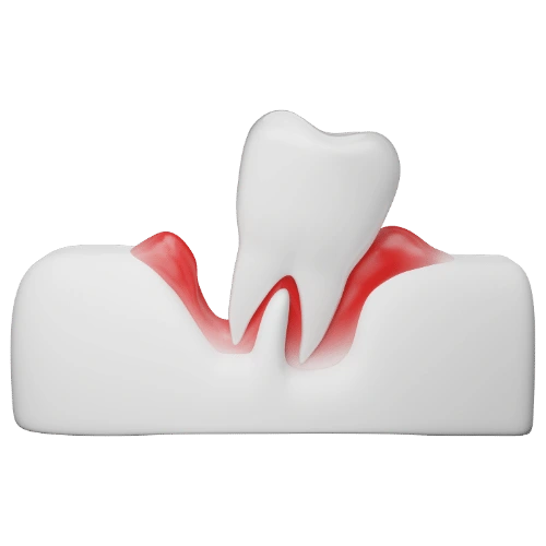 ilustracija periodontitis (parodontitis), na slici je ilustrovan zub i oko njega upalni proces desni