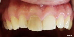 zubi prije intervencije, jedinica ima tamniju i zuću boju u odnosu na preostale zube